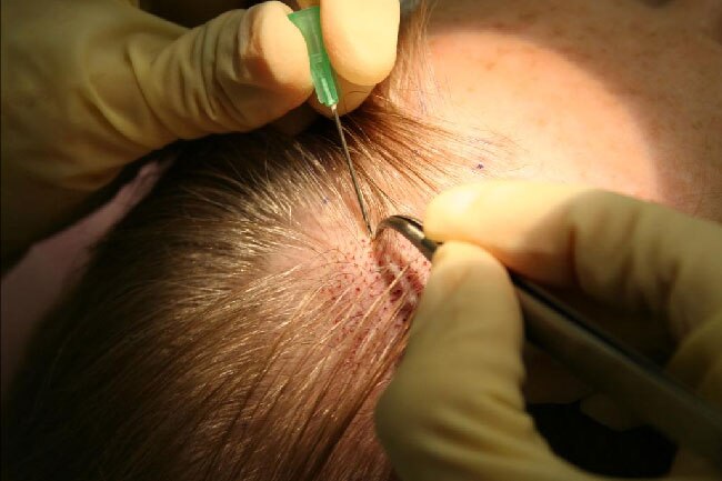 Can FUE Guarantee Proper Hair Growth?
