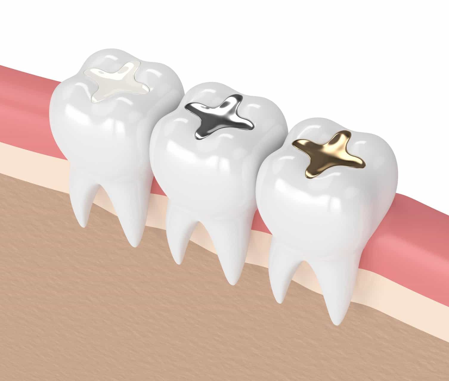 How Tooth Fillings Prevent Decay and Restore Dental Health Effectively